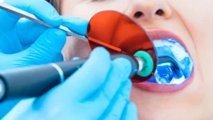 Amexors Dental+curing+light+in+patient's+mouth