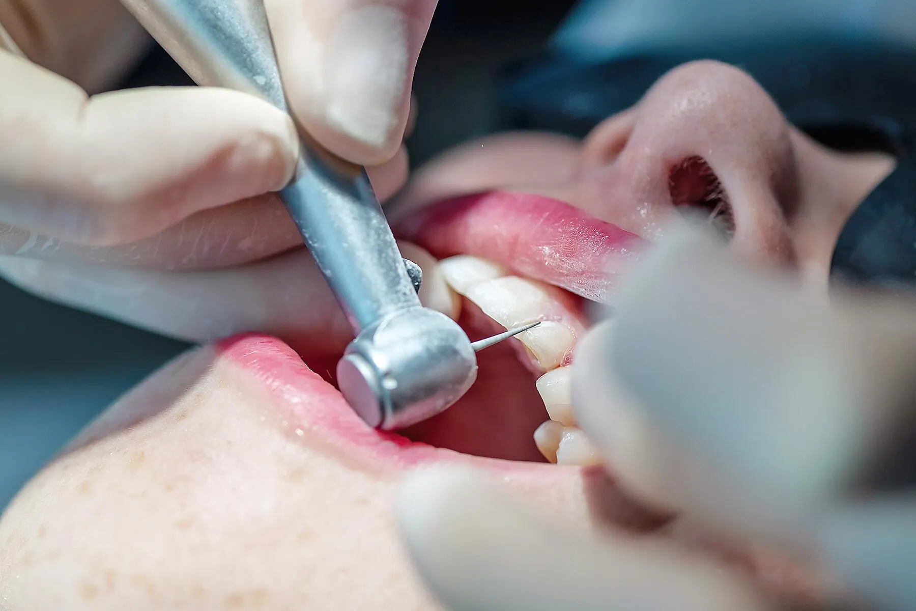 Dentist performing precise restorative cavity preparation using a high-speed dental turbine handpiece.