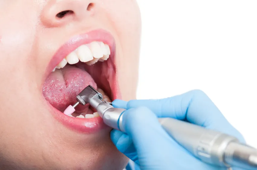 Clinical close-up of a low-speed contra-angle dental handpiece performing composite refinement and prophylaxis polishing.