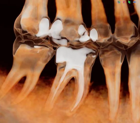 Amexors complex root canal anatomy 3D visualization
