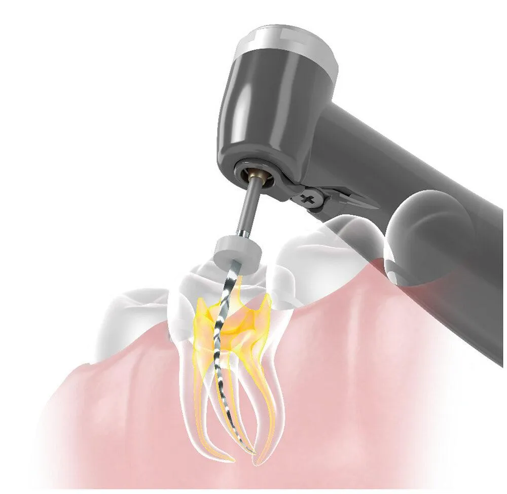 Amexors root canal preparation rotary file