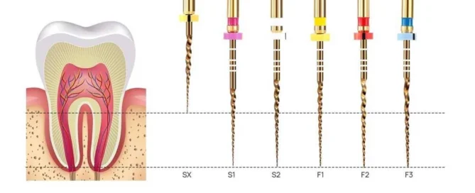 amexors NiTi rotary file system with different sizes, tapers, and file sequences