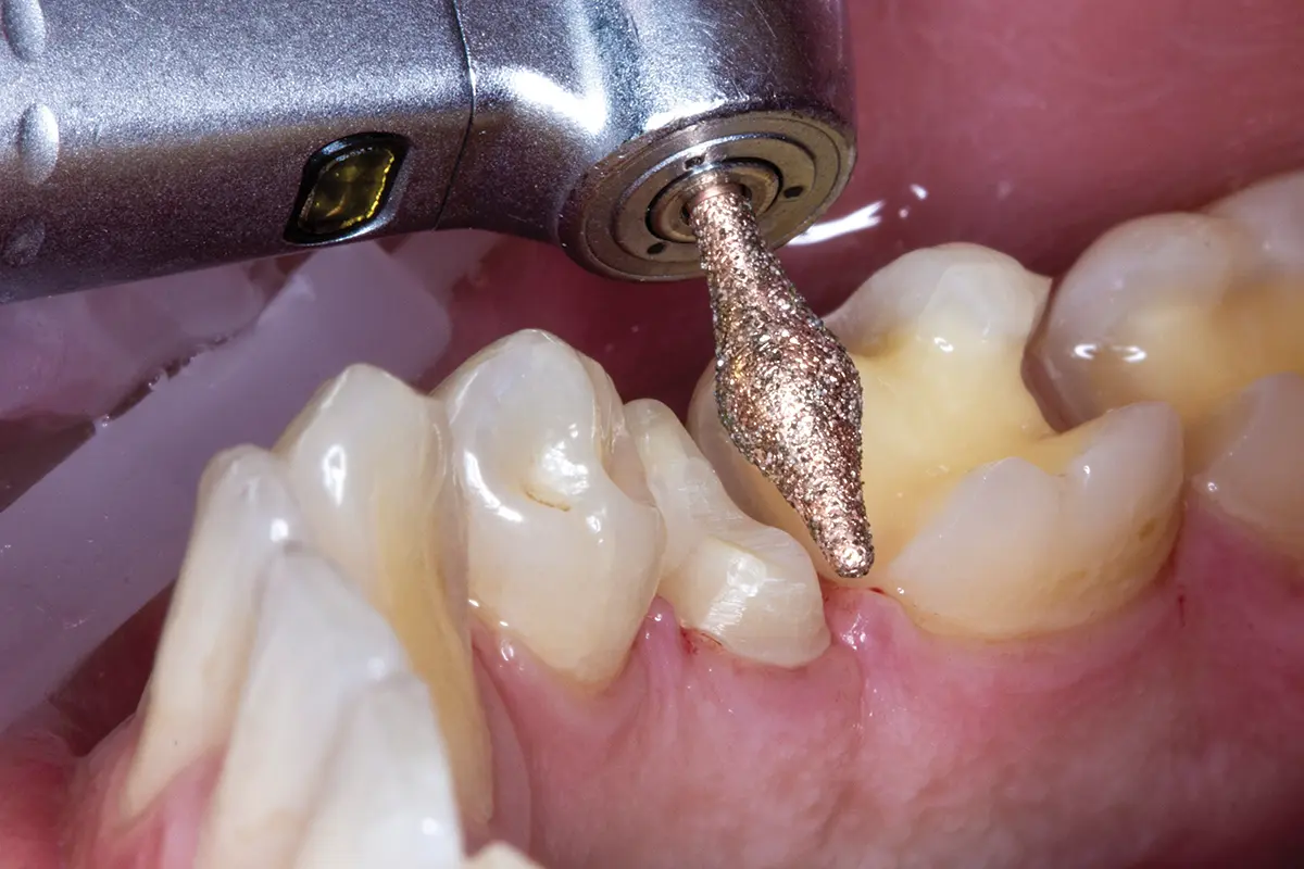 Tooth Preparation & Finishing