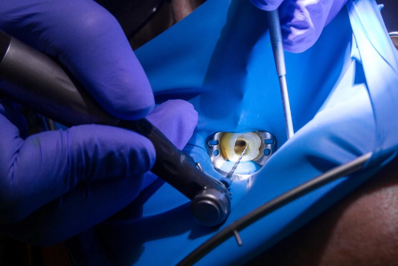 Endodontic Procedures